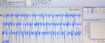 Electromyography (EMG)