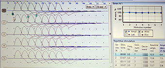 Repetitive Nerve Stimulation (RNS)